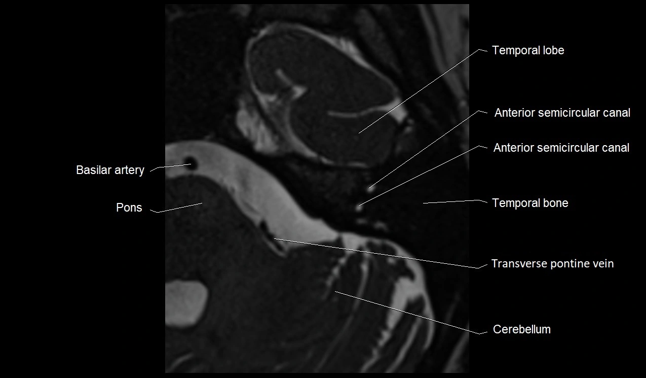 Internal auditory canal (IAC) axial cross sectional anatomy image 25.webp